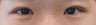 Bilateral Asian Eyelid Surgery