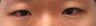 Bilateral Asian Eyelid Surgery