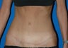 Tummy Tuck