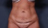 Tummy Tuck