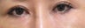 Bilateral Lower Blepharoplasty