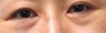 Bilateral Lower Blepharoplasty