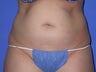 tummy tuck