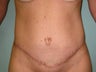 Tummy Tuck 