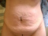 Tummy Tuck 