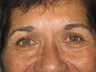 Eyelid Surgery