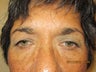 Eyelid Surgery
