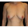 Breast Lift and Implants