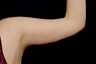 Arm Lift
