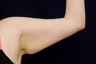 Arm Lift