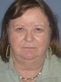 Brow Lift on 62-year-old