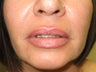  Juvederm® 