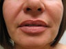  Juvederm® 