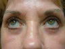 Eyelid Surgery, Lower Blepharoplasty