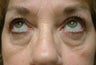 Eyelid Surgery, Lower Blepharoplasty