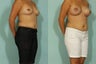Breast Augmentation