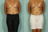 Breast Augmentation