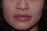 Juvederm to Lips and Smile Lines
