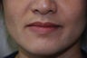 Juvederm to Lips and Smile Lines
