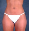 Liposuction