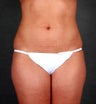 Liposuction