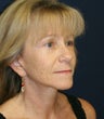 52 year old with premature aging