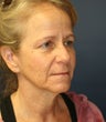 52 year old with premature aging