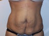 Tummy Tuck