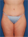 Body contouring for excess skin