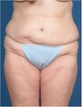 Body contouring for excess skin