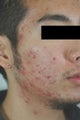 Photodynamic Therapy for Acne