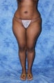 Brazilian Butt Lift