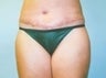 39 year old female patient 