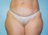 39 year old female patient 