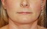 Neck Lift