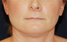 Neck Lift