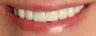 Porcelain Veneers
