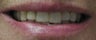 Porcelain Veneers