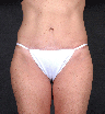 Tummy Tuck