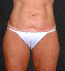 Tummy Tuck