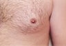 Male patient who underwent surgery for inverted nipples 
