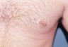 Male patient who underwent surgery for inverted nipples 