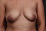 29 year old woman that underwent inverted nipple correction under local anesthesia