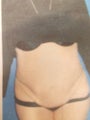 Tummy Tuck