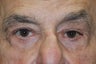 Upper and Lower Lid Blepharoplasty