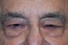 Upper and Lower Lid Blepharoplasty