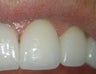 Porcelain Veneers