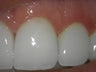 Porcelain Veneers