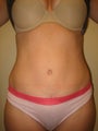 Tummy Tuck