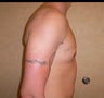26 year old man has Gynecomastia Surgery